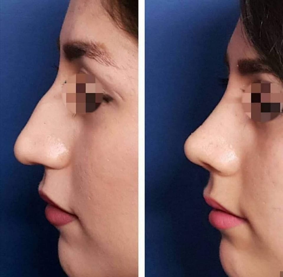 photo avant apres rhinoplastie en tunisie