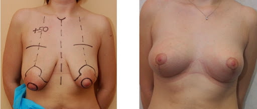 Före- och efterbild av bröstförstoring
