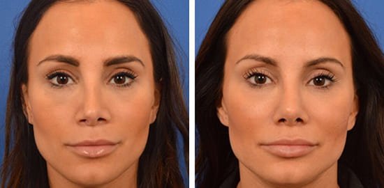 Photo avant après d'une rhinoplastie secondaire à Istanbul