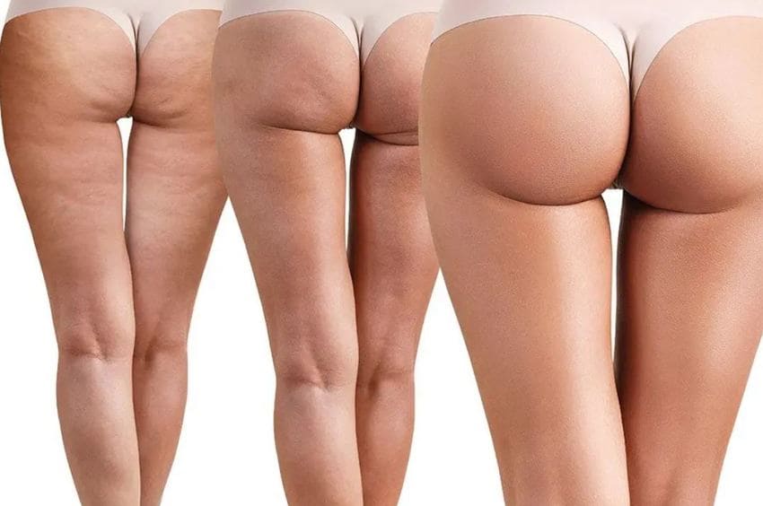 Amélioration des fesses avec un lifting brésilien