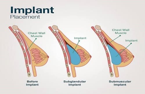 Diagram över implantation av bröstimplantat under och över muskeln