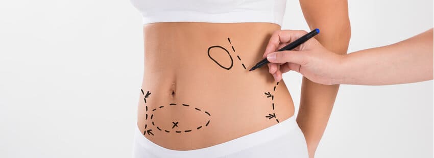 Tracé pour un Mommy Makeover