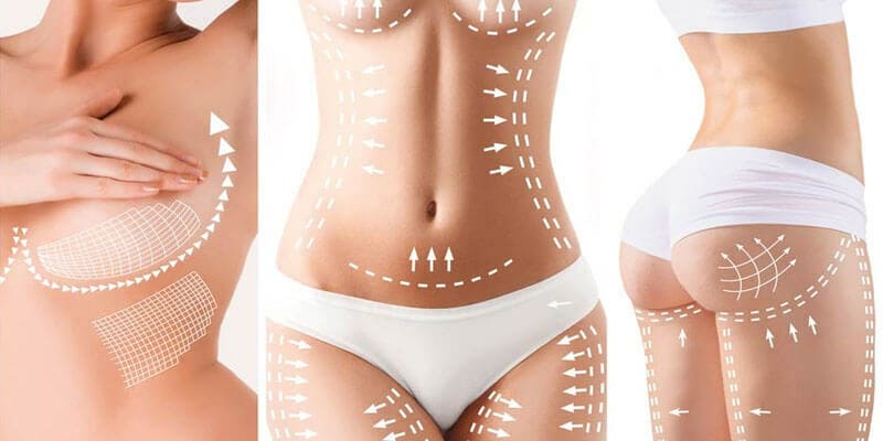 Silhouhette féminine avec tracés du chirurgien