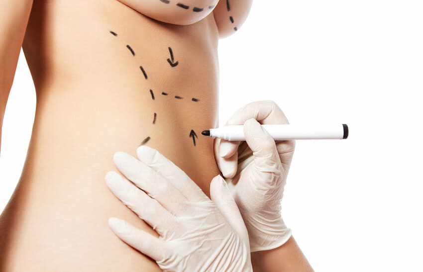 Tracé d'un chirurgien pour un Mommy Makeover