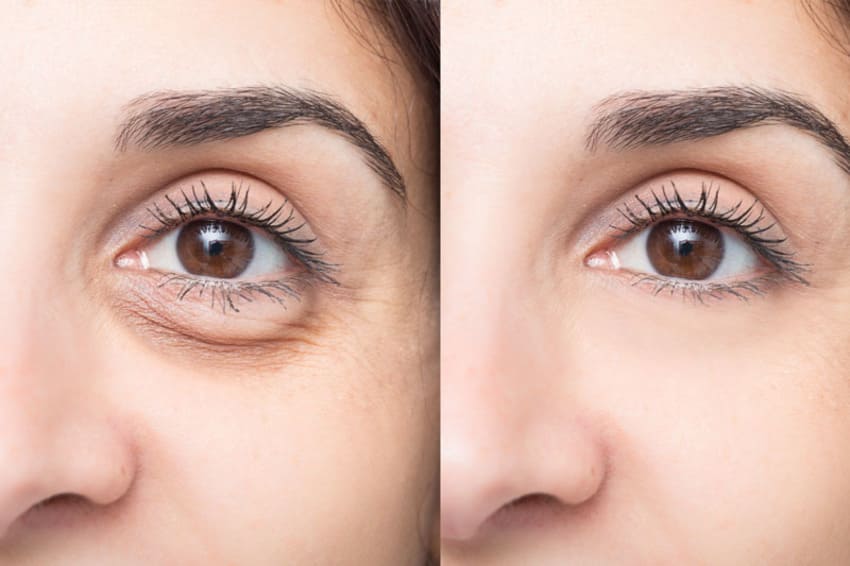 Simulation photo avant et après d'une bichectomie