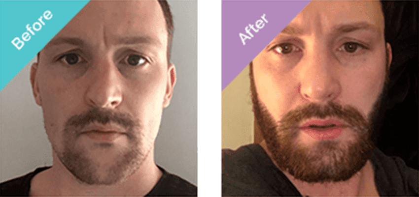 Photo avant et après une greffe de barbe en Turquie