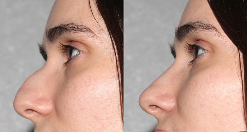Photo avant et après une rhinoplastie ultrasonique