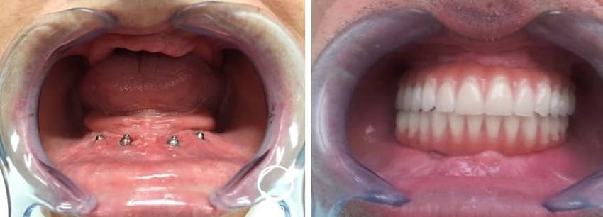 Implant dentaire sur 4 piliers