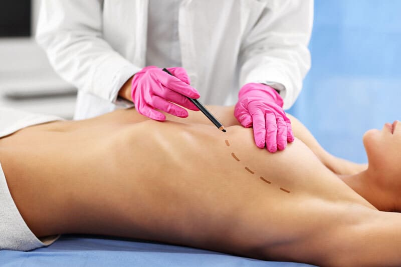 Tracé du chirurgien pour une mastopexie