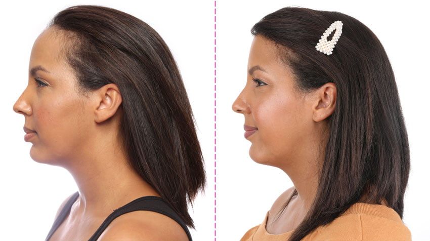 Photo avant et après d'un abaissement de la ligne frontale