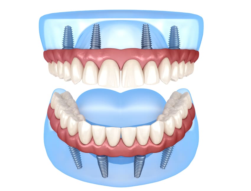 Image de synthèse d'une mâchoire supérieure et inférieure avec un All-on-4