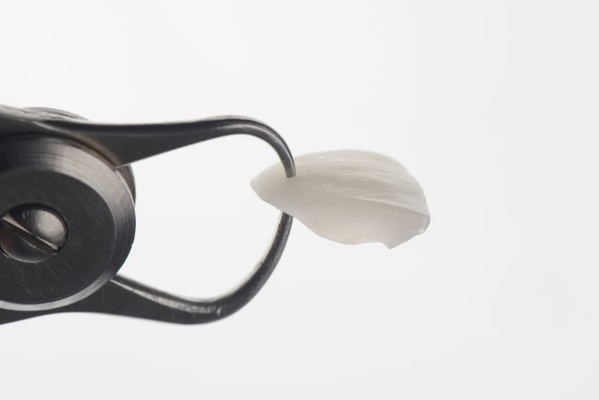 Coquille de facettes dentaires