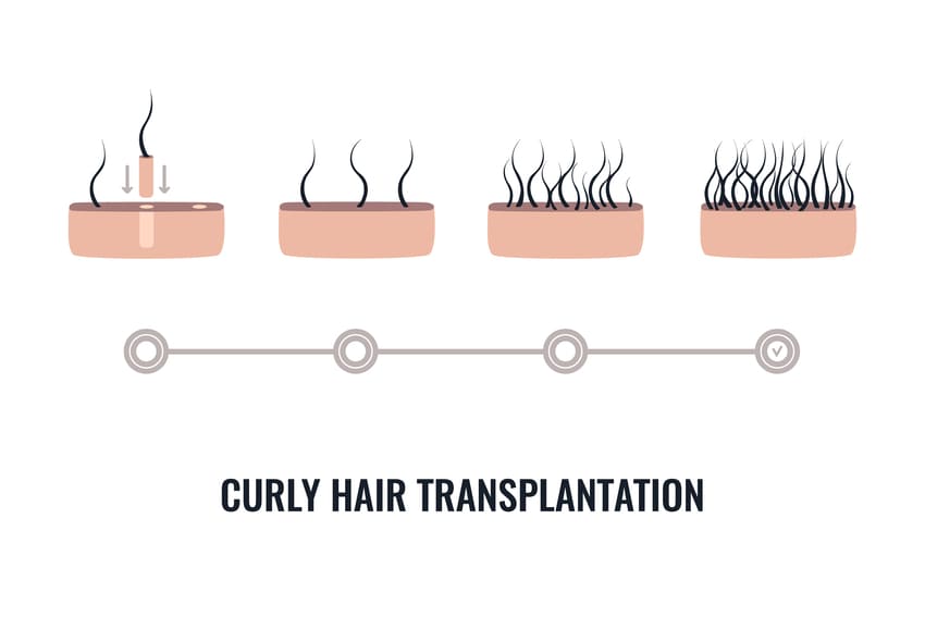 implantation de cheveux crépus