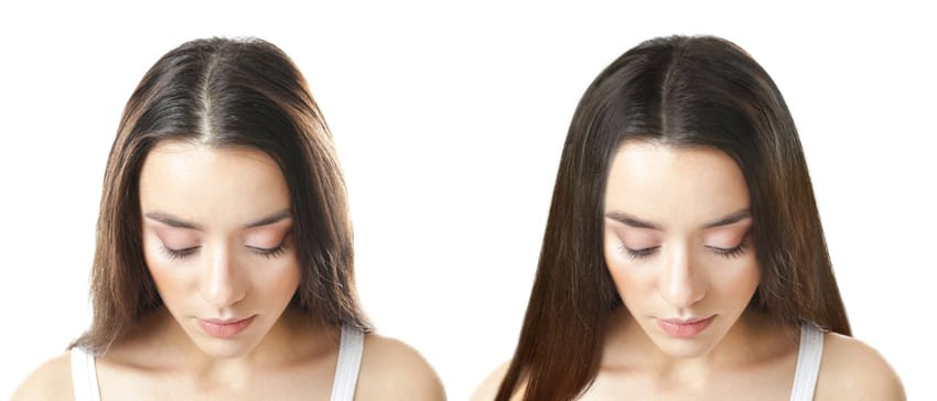 Simulation avant et après une greffe de cheveux pour femme