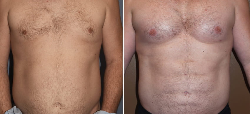 Photo avant et après des implants pectoraux