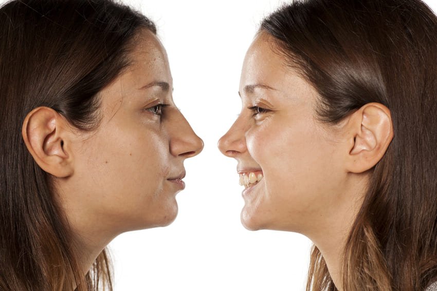 Photo avant après d'une rhinoplastie d'une femme blanche