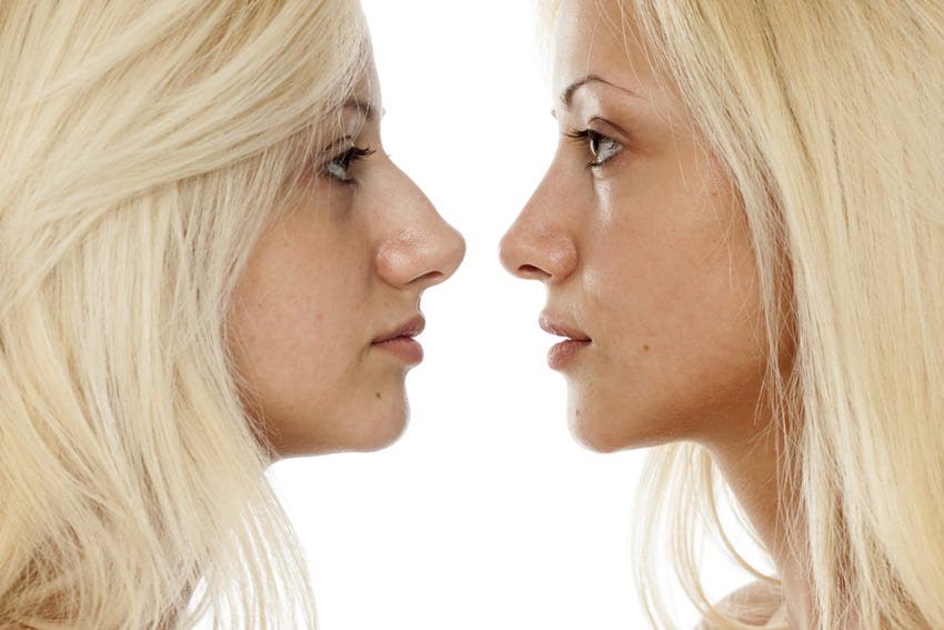 Photo avant après d'une rhinoplastie d'une femme blonde