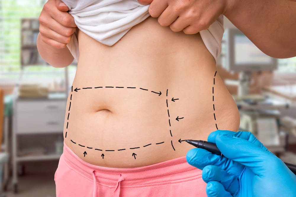 Tracé d'une liposuccion abdominale