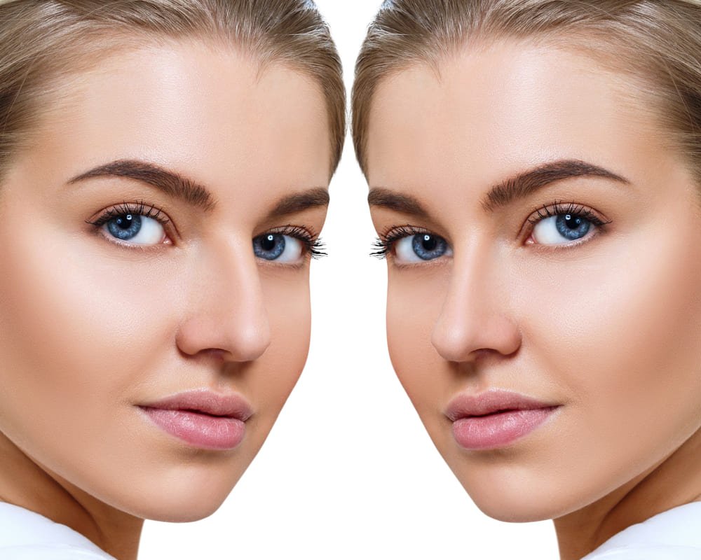 Simulation avant et après d'une rhinoplastie