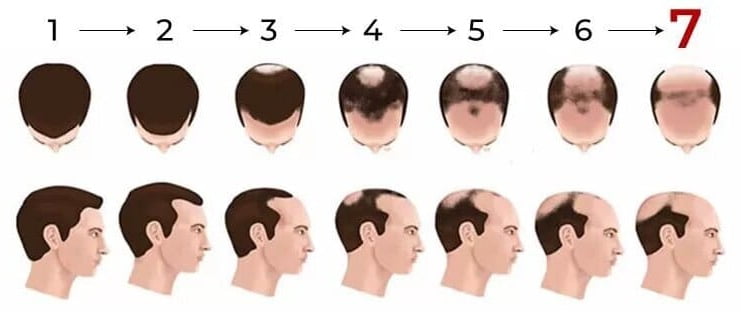 Schéma de l'échelle de Norwood de la calvitie