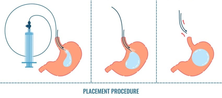Procédure de mise en place du ballon gastrique