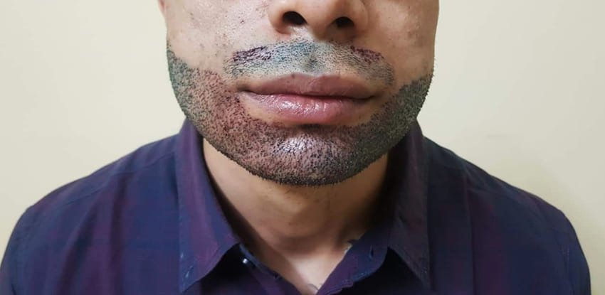 Patient après une greffe de barbe