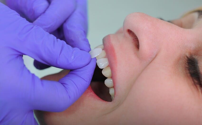 Différence entre vraies dents et facettes dentaires