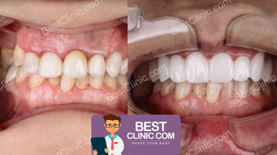 avant apres facette dentaire turquie