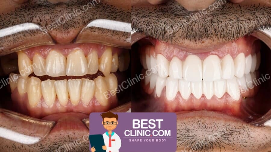 avant apres facette dentaire turquie