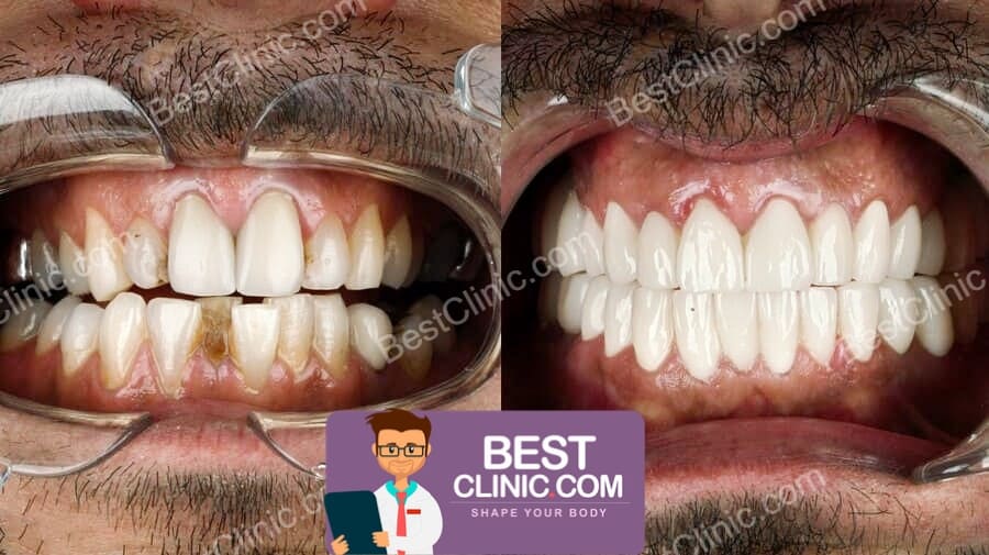 avant apres facette dentaire turquie