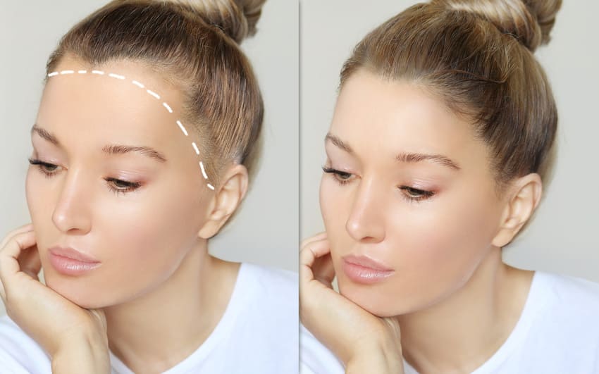 Simulation de la réduction du front chez la femme