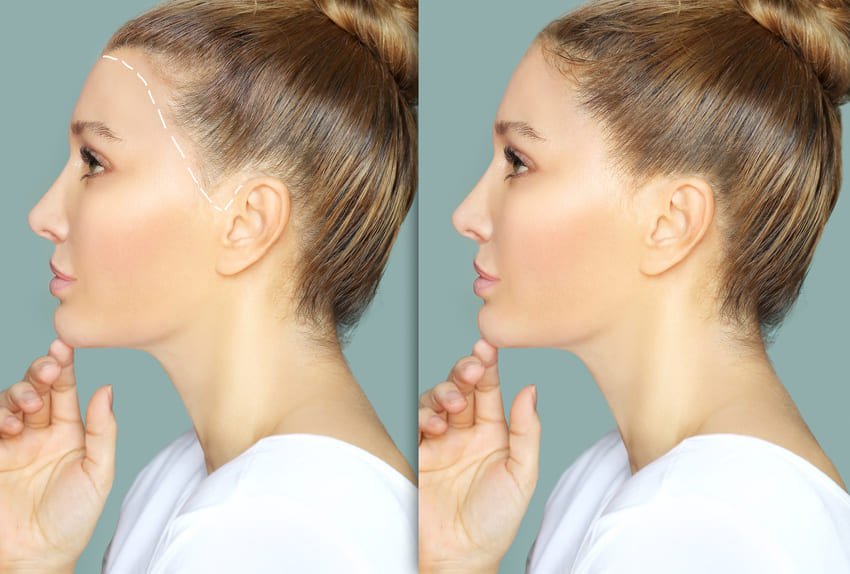 Simulation de la réduction de la ligne frontale