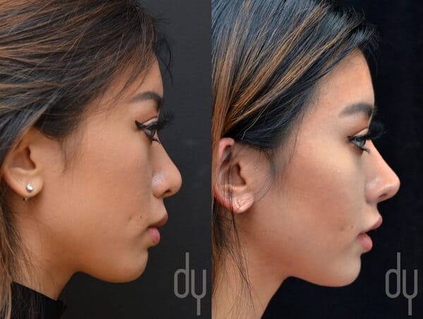 Photo avant et après d'une rhinoplastie ethnique sur femme asiatique